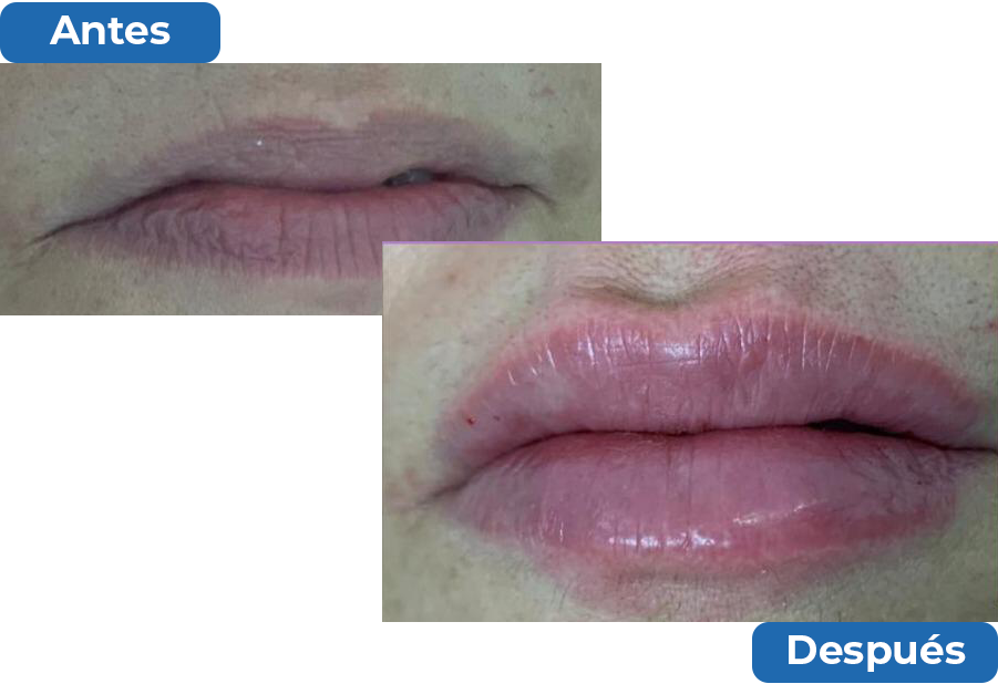 aumento de labios doctora del rosario